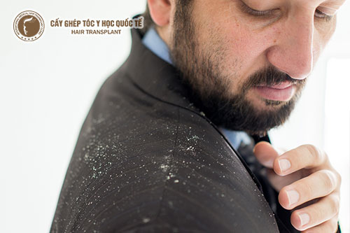 Tóc rụng và nhiều gàu – Làm sao xua tan nỗi lo này