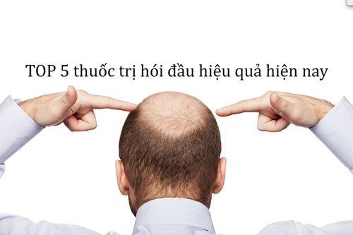 Top 5 thuốc trị hói đầu hiệu quả và bán chạy nhất hiện nay