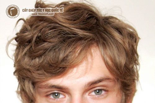 Mách bạn cách trị hói đầu ở nam giới, kích thích tóc mọc lại nhanh chóng