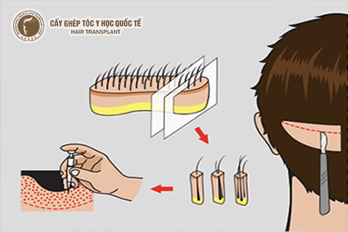 Cấy tóc giá rẻ có hiệu quả không?