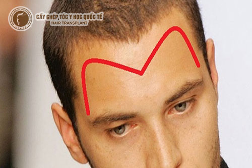 Bị hói chữ M có chữa được không? Phương Pháp Điều Trị Như Thế Nào Hiệu Quả?