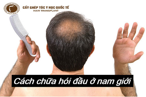 Trị hói cho nam giới dứt điểm bằng cách nào?