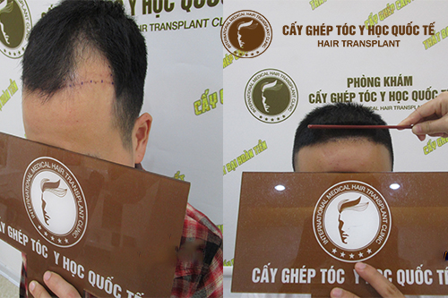 Cấy tóc 2018 – Ranh giới của sự khác biệt