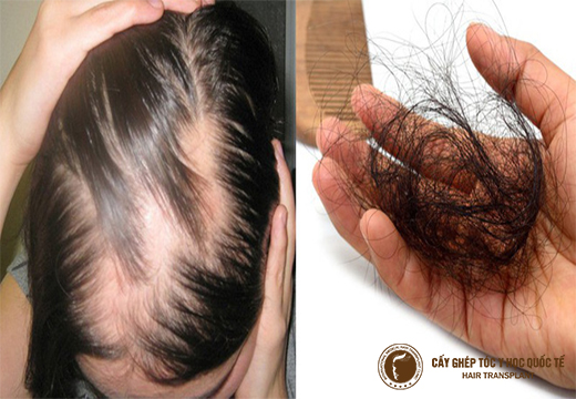 Điều trị rụng tóc công nghệ sinh học những điều cần biết