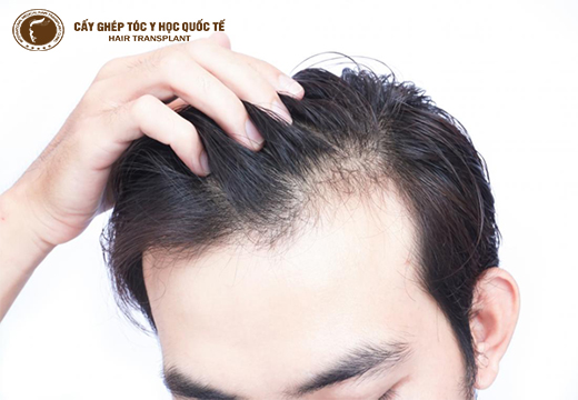 Nguyên nhân bị hói trán, 2 bên trán và phương pháp điều trị hiệu quả nhất