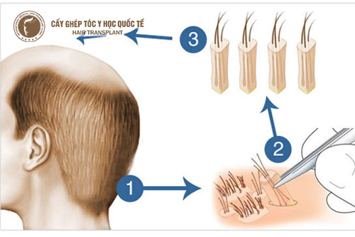 Cấy tóc là gì? Những điều cần biết khi đi cấy tóc