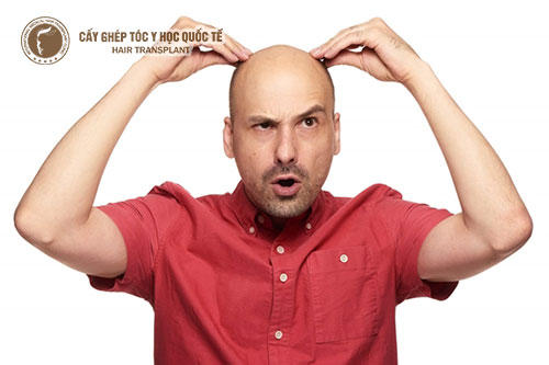 Nguyên nhân gây hói đầu ở cả nam và nữ giới