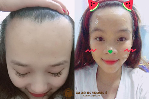 Trán cao đâu phải chuyện to tát, đã có cấy tóc tự thân lo!