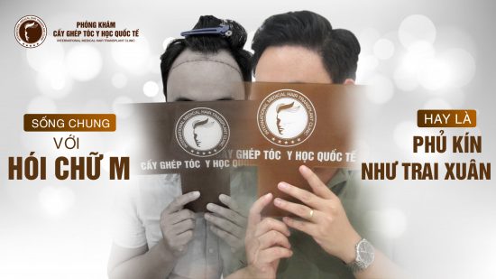 Khắc phục đầu hói hiệu quả chỉ với một lần thực hiện