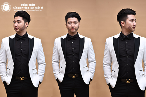 Cấy râu cho nam giới và những điều cần biết?