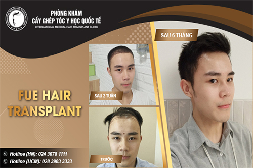 Tìm được cách trị hói dứt điểm sau 4 năm bế tắc