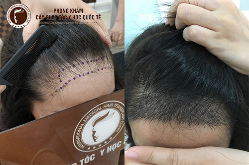 Phương pháp xử lý tóc bò liếm không phải ai cũng biết