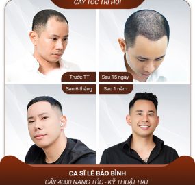 Cấy tóc trị hói biện pháp kích thích tóc mọc hiệu quả trở lại