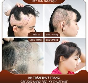 Giải đáp: Cấy tóc trên sẹo có đau không?
