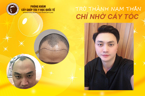 Vương Quốc Anh – Trở thành nam thần chỉ nhờ cấy tóc tự thân