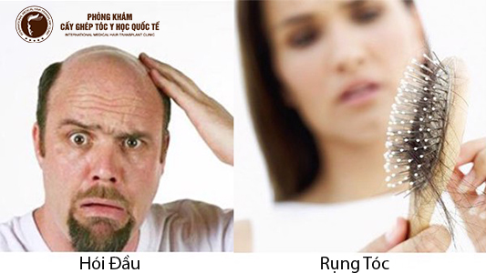 Làm thế nào để thoát khỏi nỗi khổ rụng tóc?