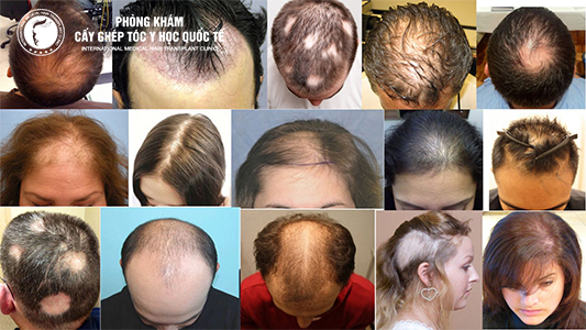 Đi tìm nguyên nhân và cách trị rụng tóc từng mảng hiệu quả nhất