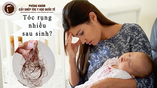 Cách trị rụng tóc sau sinh hiệu quả mà mẹ bỉm sữa nào cũng cần phải biết