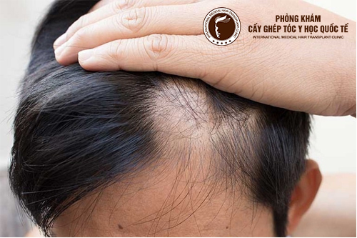 Rụng tóc 2 bên thái dương điều trị như thế nào?