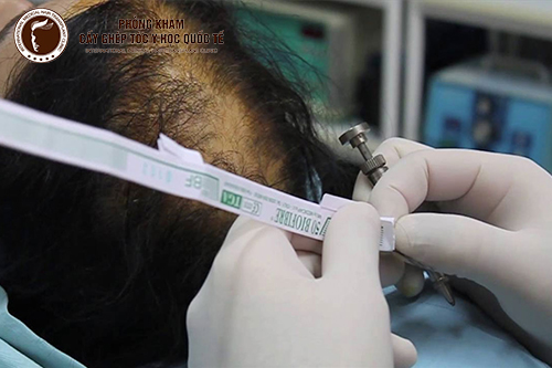 Hiệu quả khác biệt của cấy tóc sinh học và cấy tóc tự thân