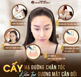 Cấy đường chân tóc có hiệu quả thực sự?