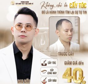 Review hành trình cấy tóc của ca sĩ Lê Bảo Bình