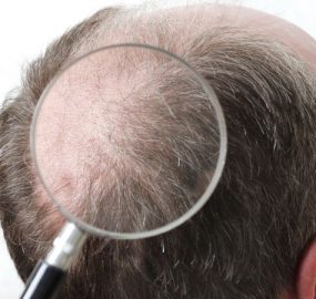 Giải mã 2 công nghệ cấy tóc DHI và HAT: Khác biệt nằm ở đâu?